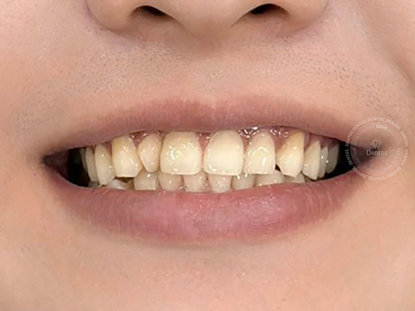 Đối với các răng ố vàng nên tẩy răng để bảo tồn răng thật